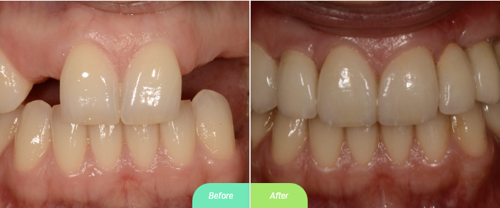 before after, Bone Graft and implants crowns