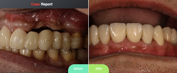 before after, bone graft and implants and crowns