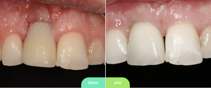 fixing bad implant placement with bone graft and soft tisuue grafting